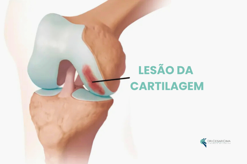 Lesão da Cartilagem ( Defeitos Condrais )